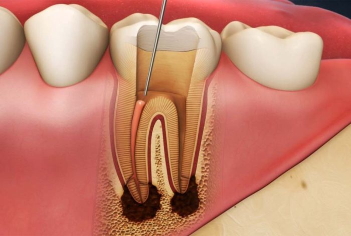 Endodontic