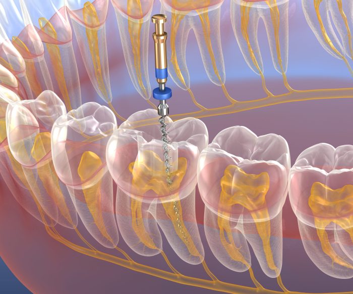 Which term most accurately identifies root canal therapy