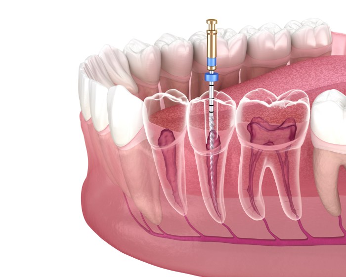 Which term most accurately identifies root canal therapy